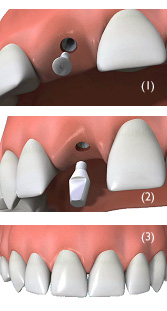 Implants at Aquila Dental