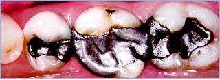 Silver fillings are noticeable and therefore undesirable!